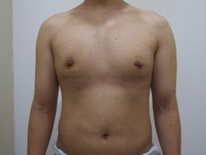 수술후 앞면