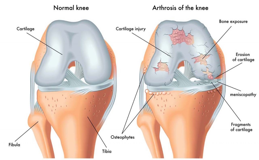 Osteoarthritis_Knee